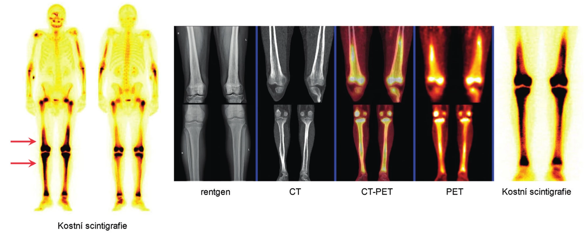 Pro Erdheimovu-Chesterovu nemoc je typická osteoskleróza
dlouhých kostí dolních končetin<br>
Velmi dobře ji znázorňuje scintigrafie kostí (radiofarmakum technecium
pyrofosfát), ale je velmi dobře prokazatelné pomocí FDG-PET/CT
zobrazení, které zobrazí zvýšenou akumulaci fluorodeoxyglukózy ve
stejných lokalizacích. Na rentgenovém či CT zobrazení těchto lokalit se
zvýšenou akumulací Tc-pyrofosfátu a fluorodeoxyglukózy je pak dobře
patrná osteoskleróza.