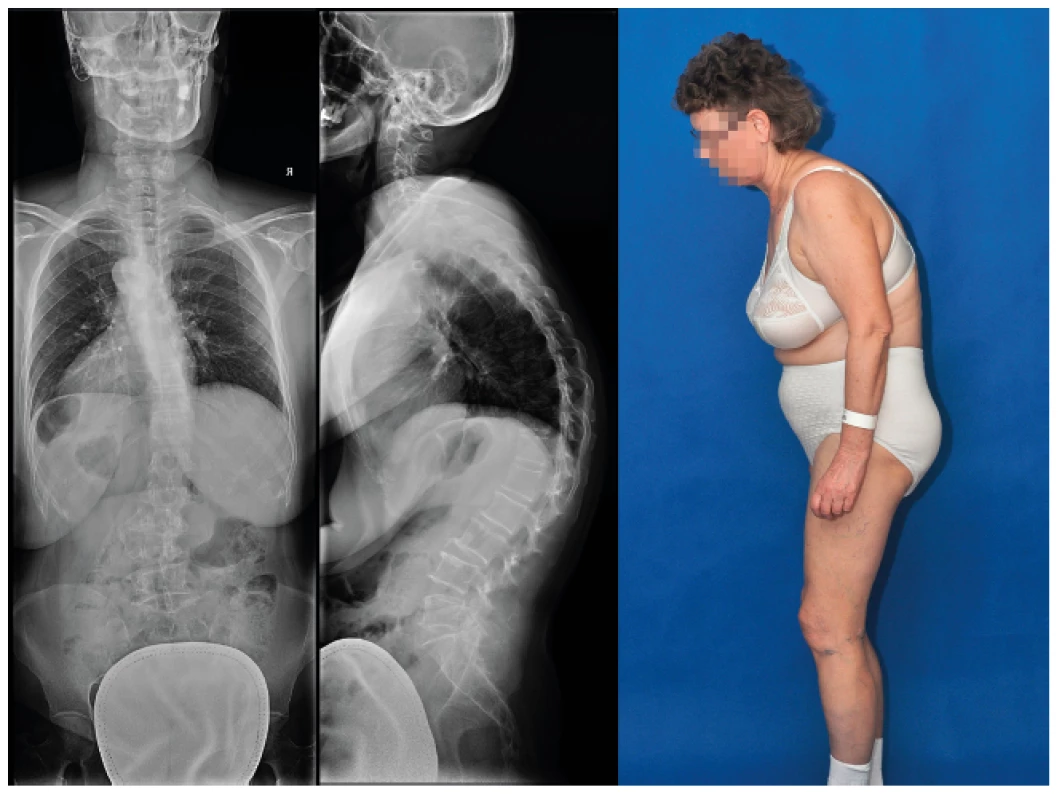 Rtg snímek páteře, vlevo na zadopředním degenerativní skolióza, uprostřed na
bočním zvýrazněná hrudní kyfóza, vpravo klinický obraz s přední dekompenzací a ohnutím
dopředu