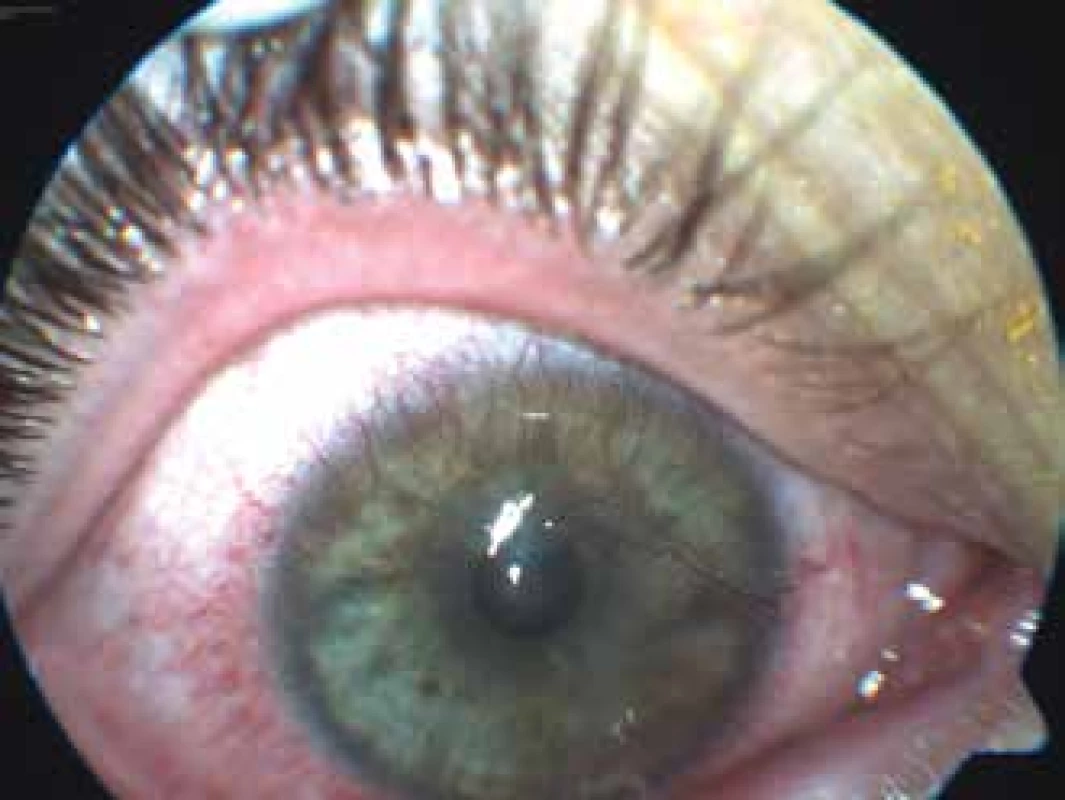 Pravé oko u pacientky z kazuistiky 1, viditelná smíšená vaskularizace rohovky