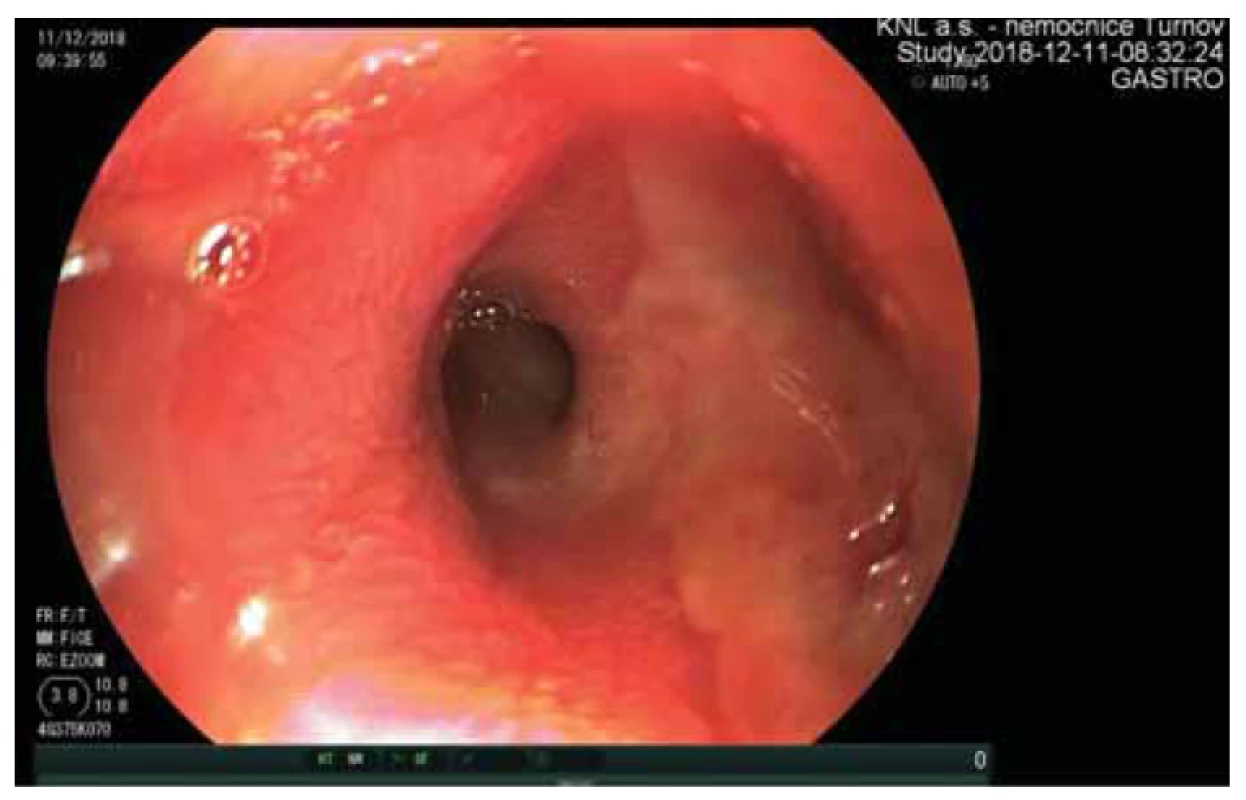 Iniciální endoskopický nález exulcerované sliznice proximálního jejuna.<br>
Fig. 1. Initial endoscopic finding of exulcerated mucosa of the proximal jejunum.