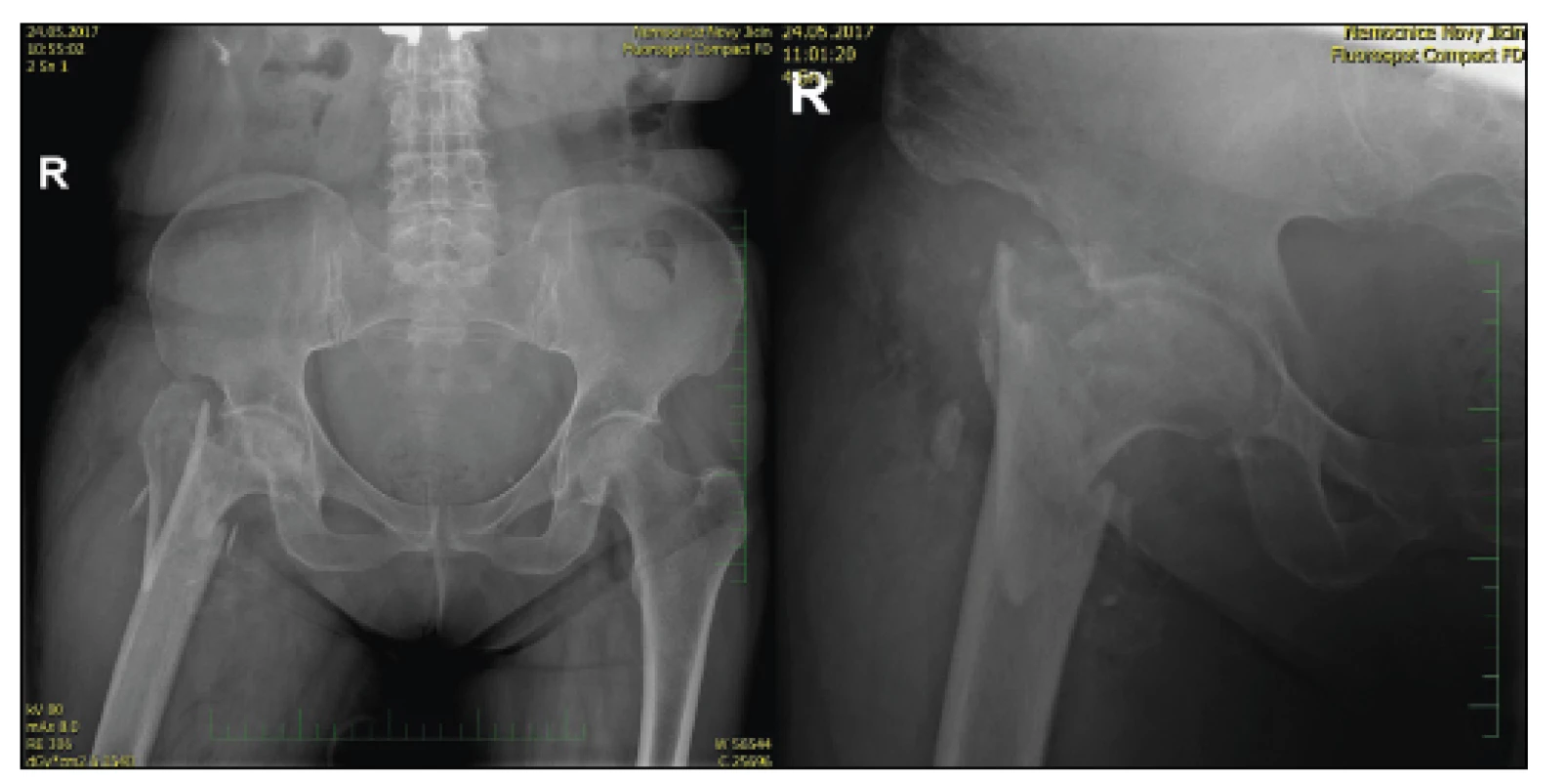 70letá žena s tříštivou zlomeninou trochanterického masivu a
nekrózou hlavice femuru, úrazový RTG