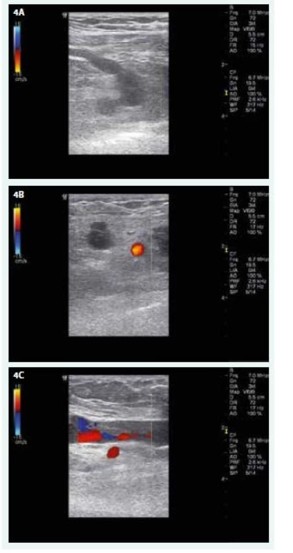 USG nález na žilách PHK před zahájením
domácí antikoagulační léčby LMWH. A – úplný
uzávěr v. subclavia a jejího přítoku (CFM, příčné
zobrazení) B – úplný uzávěr v. axillaris, červeně
se barví krevní průtok tepnou (CFM, příčné
zobrazení) C – distální konec trombózy ve
v. brachialis asi 10 cm nad loketní jamkou (CFM,
podélné zobrazení)