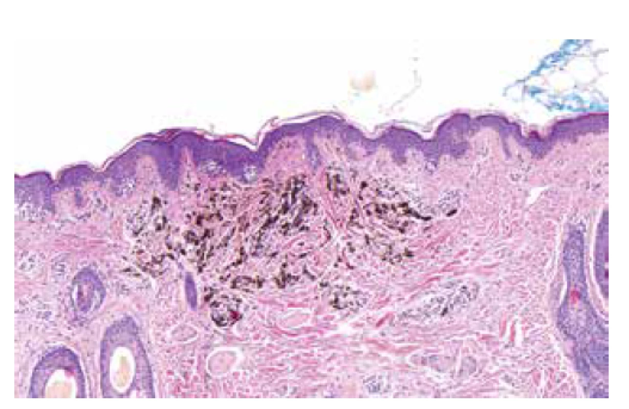 Histopatologický obraz (HE, 100x)