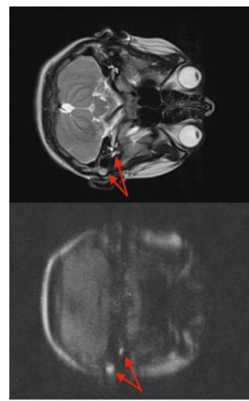 a 4 MRI – T2 zobrazení a difuzní zobrazení, axiální rovina:
chlapec, 14 let, stav po atikoantrotomii vlevo před rokem,
na kontrolním MRI dvě suspektní léze cholestetomu. První
větší v laterální části trepanační dutiny téměř v podkoží,
druhá porce cholesteatomu v předním atiku u fossa
supratubaris (červená šipka)