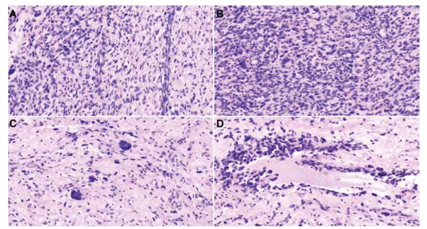 histologické preparáty barvené hematoxylinem-eosinem zobrazující vřetenobuněčný tumor s kolagenním a částečně myxoidním stromatem
a s kolísající celularitou (A, 40x). V hypercelulárních úsecích jsou patrné paralelně uspořádané blandní bazofilní vřetenité buňky vzhledu fibroblastů
(B, 40x). Fokálně nacházíme obrovské vícejaderné buňky s věnčitě uspořádanými jádry, tzv. “floret-cells” (C, 40x). Ve stromatu jsou místy
pseudovaskulární prostory lemované obrovskými buňkami a pleomorfními vřetenitými buňkami s hyperchromními jádry (D, 20x).