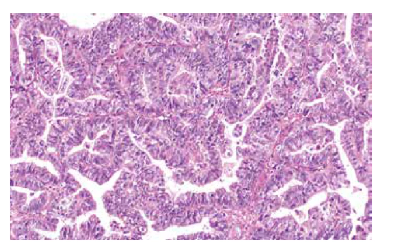 High grade serózní karcinom ovaria s tzv. SET rysy (v tomto případě
pseudoendometroidní morfologie) (barvení HE, 200x).
