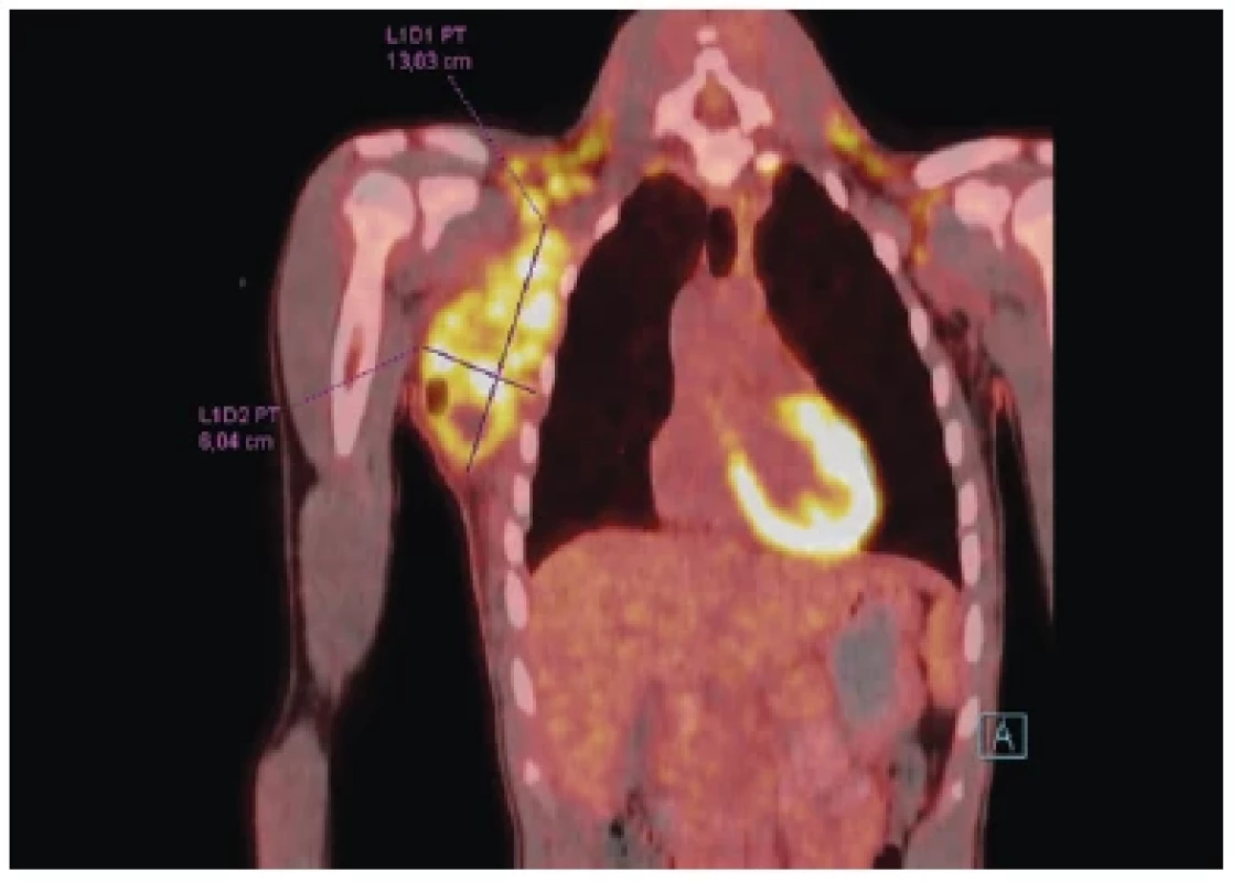 PET/CT zobrazení dokumentující rozsah a lokalizaci lymfadenopatie