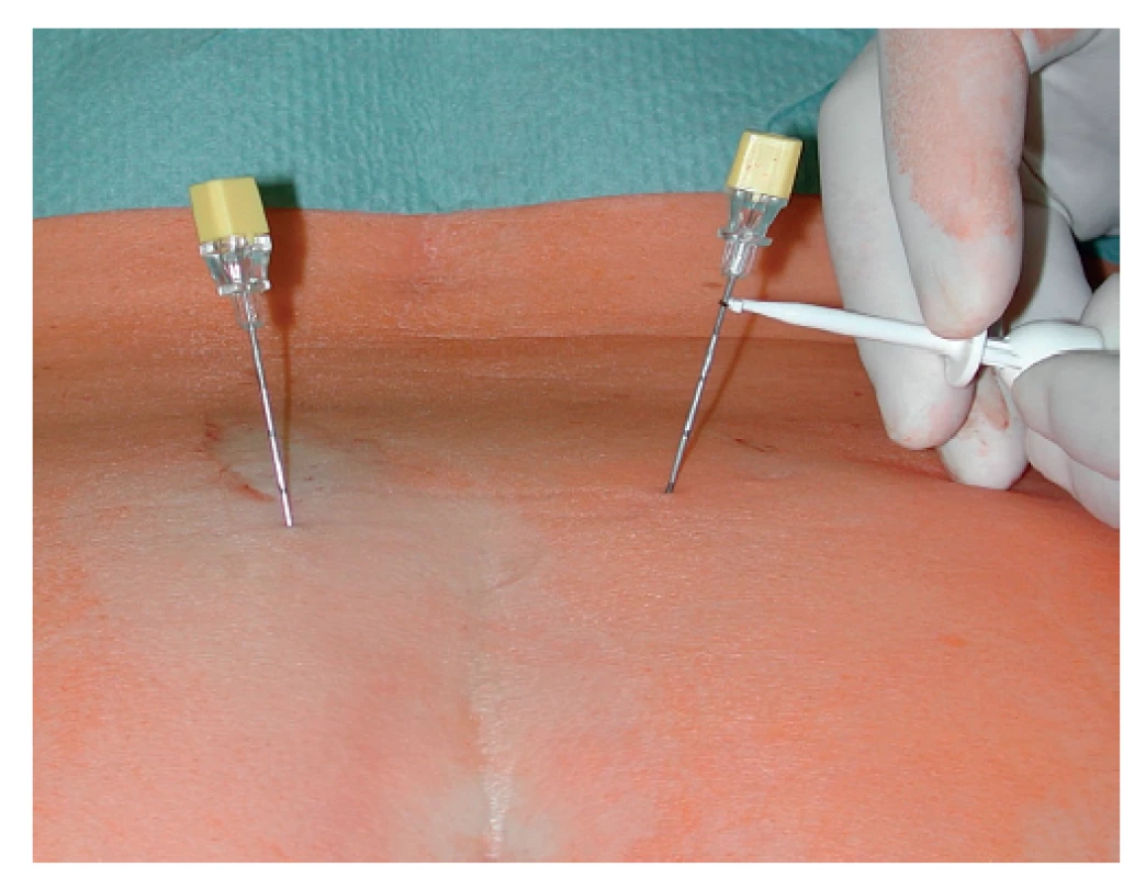 Stimulační elektrody zavedené do foramen sacrale
dorsale a zahájení stimulace<br>
Fig. 1: Sacral foramen needle positioning and initiation of
stimulation