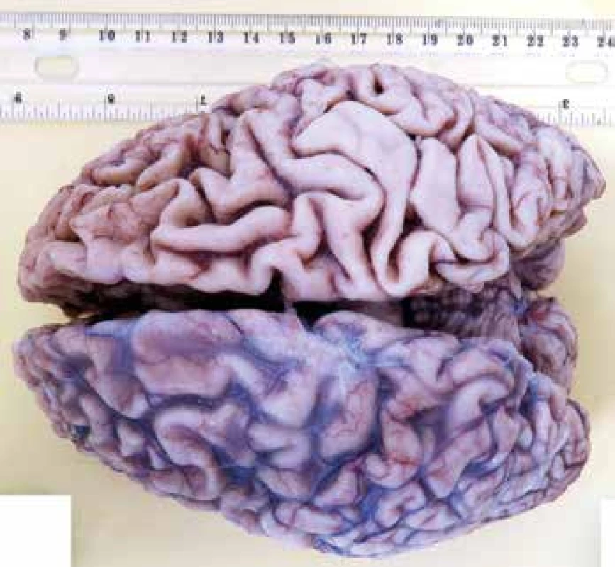 Pohľad na hornú plochu mozgu s odstránením mäkkých plien vpravo.
