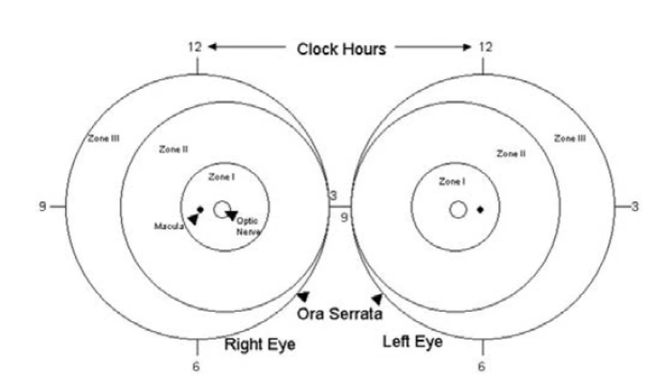 Klasifikace retinopatie nedonošených (ROP) podle
lokalizace