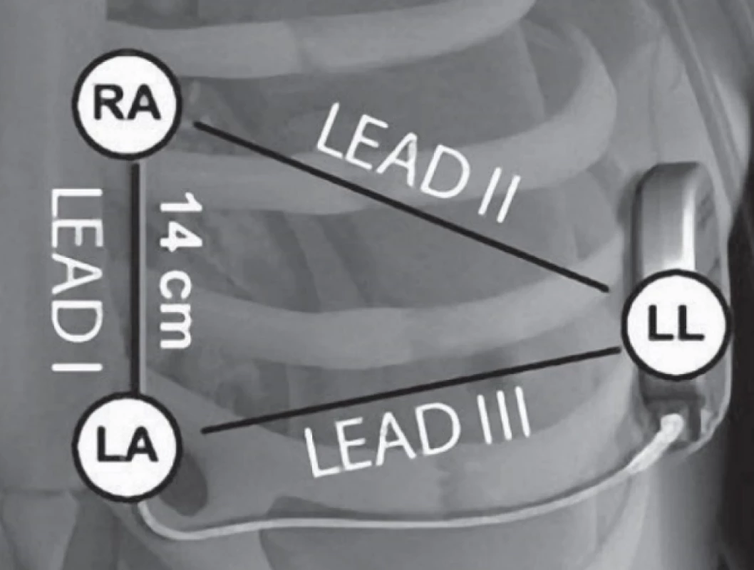 The placing of S-ICD system and sensing vectors: primary (Lead III), secondary (Lead II) and alternate (Lead I). The ECG lead wire colors corresponds
to the traffic light colors: RA = red, LA = yellow, LL =
green [6].