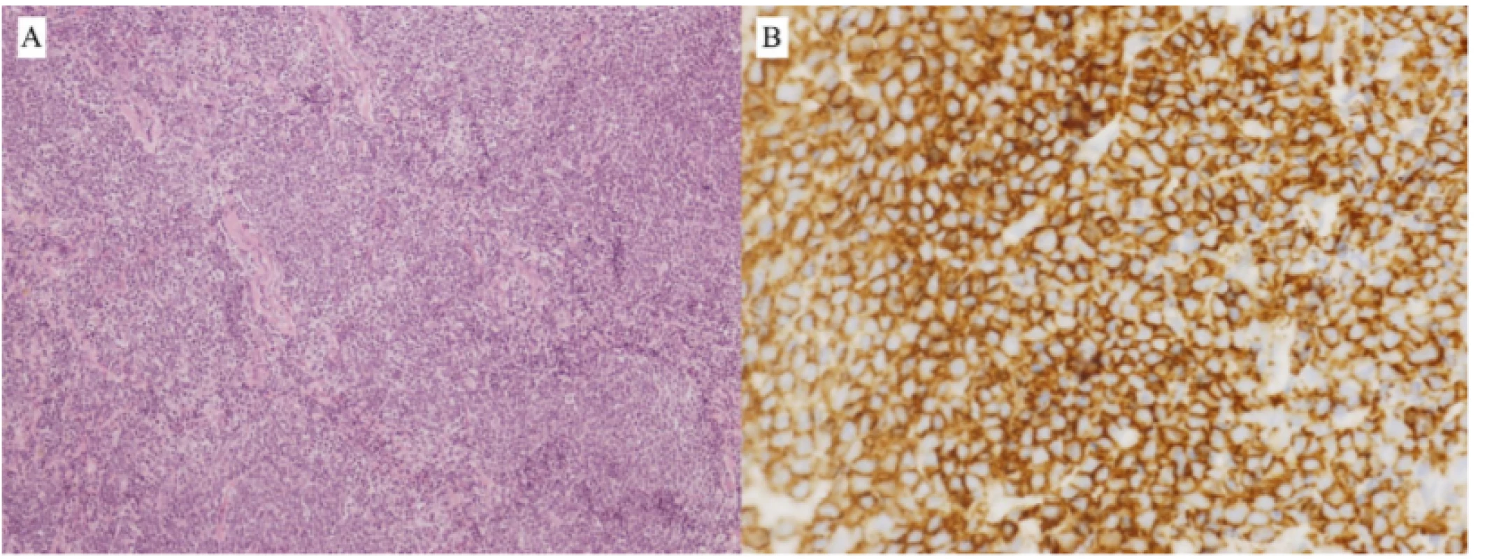 Fig. 3. Patient 1 – B-NHL type MCL, biopsy finding:<br>
A) Infiltration of soft tissues by dense, pseudonodular growing tumorous lymphoproliferation from<br>
small to medium-sized lymphoid cells (HE, enlargement 100x)<br>
B) Immunohistochemical positivity of CD20+ marker in tumour cells (enlargement 400x)