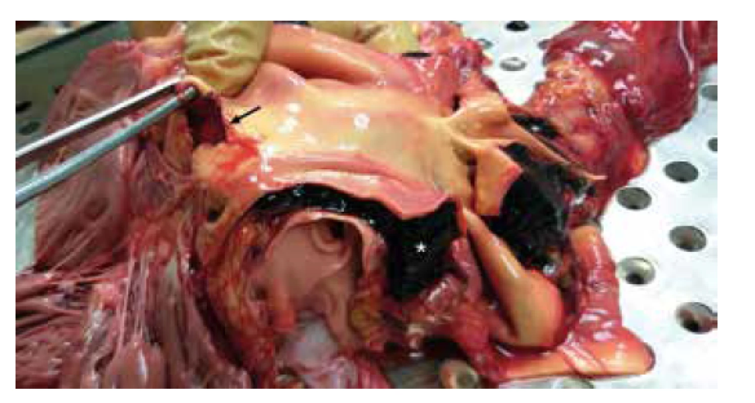 Trhlina v cévní stěně (šipka) a intramurální hematom (hvězdička). <br>
Fig.2. Tear within a vessel wall (arrow) and intramural hematoma (star).