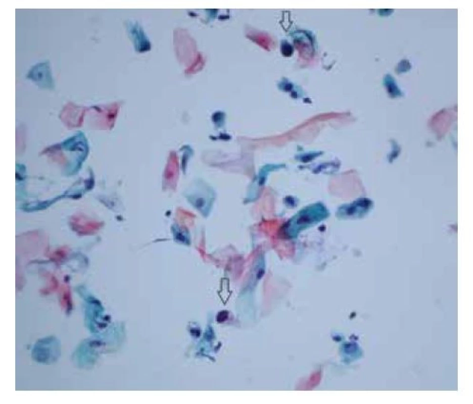 HSIL (high-grade skvamózní intraepiteliální léze)
– vzácné malé dysplastické buňky (šipky) skvamózního
původu s vysokým nukleocytoplazmatickým poměrem
a tmavým nepravidelným jádrem<br>
(barvení podle Papanicolaou, zvětšení 400x)