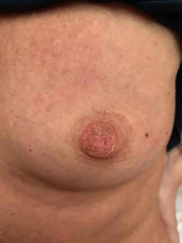 Pagetova choroba prsu − změny na mamile přecházející na kůži areoly <br>
Fig. 2: Paget’s disease of the breast − changes of the nipple spreading to the skin of the areola 