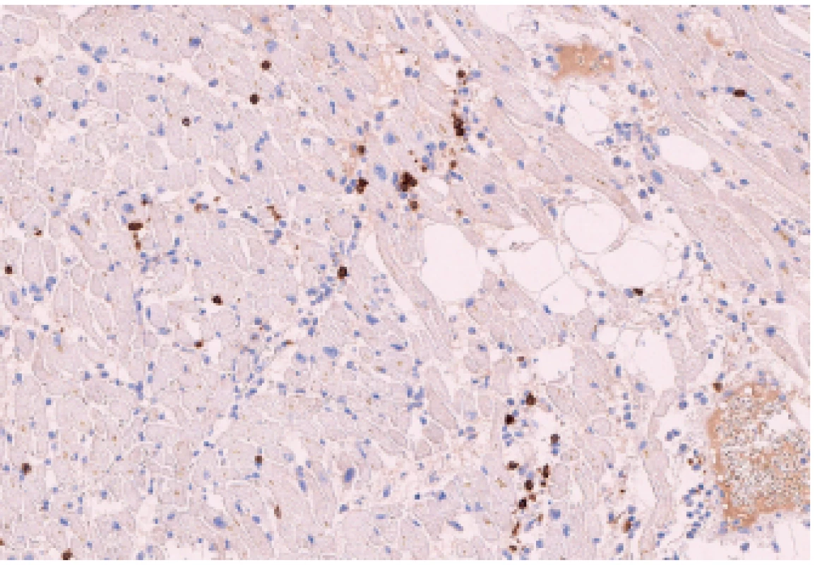 Zánětlivá celulizace v myokardu pravé komory - T-lymfocyty (CD3,
150x). 