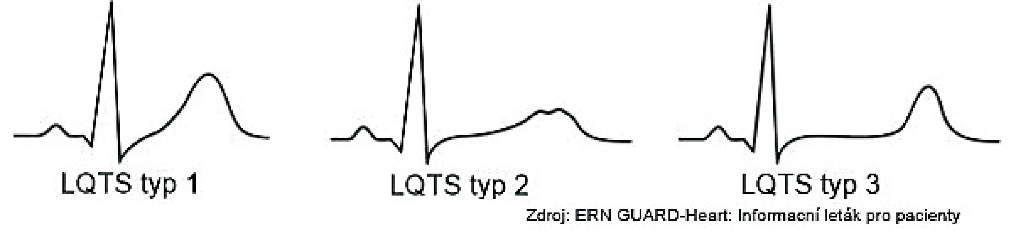 Syndrom dlouhého QT intervalu typ 1, 2 a 3