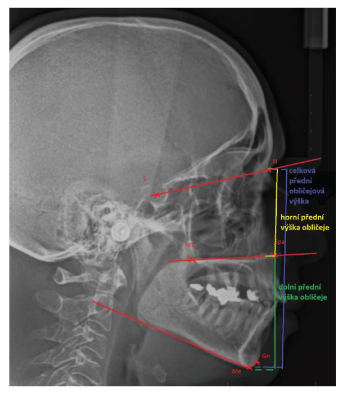 Vysvětlení pojmu „přední
obličejová výška“ na
laterálním kefalometrickém
snímku<br>
N: nasion;<br>
S: střed sella turcica;<br>
Spp: bod ležící nejvíce vzadu
na spina nasalis posterior;<br>
Spa: bod ležící nejvíce vpředu
na spina nasalis anterior;<br>
Me: menton, bod nejníže
na symfýze mandibuly;<br>
Gn: gnathion, bod ležící
v mediánní rovině na
spodním okraji dolní čelisti
nejvíce vpředu<br>
Fig. 3 Lateral cephalogram
expressing the term „anterior
facial height“<br>
N: nasion;<br>
S: the middle of sella turcica;<br>
Spp: the most posterior point
on spina nasalis posterior;<br>
Spa: the most anterior point
on spina nasalis anterior;<br>
Me: menton, the lowest point
on mandibular symphysis;<br>
Gn: gnathion, the lowest point
of the midline of the lower jaw