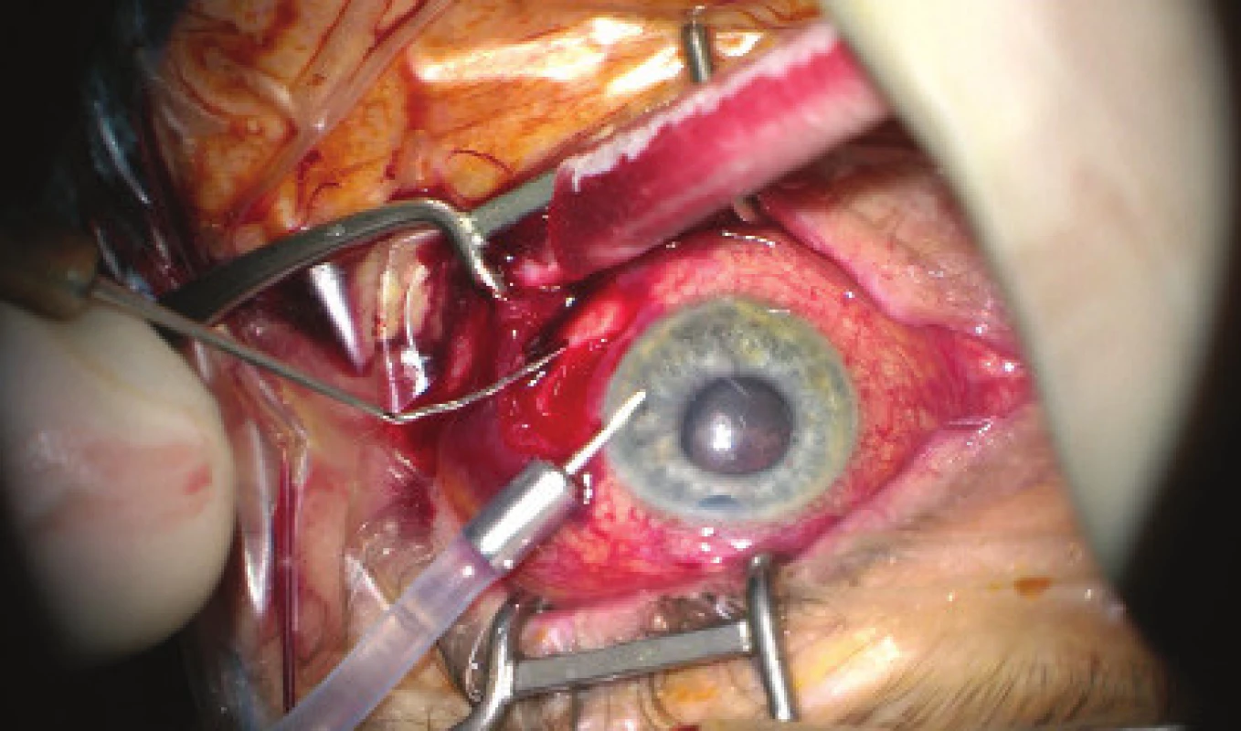Initial phase of surgical procedure, evacuation of
haemorrhage by sclerotomy, release of intraocular hypertension,
anterior chamber created from viscose material,
eyeball later toned with infusion inserted into anterior
chamber. In the retrolental space, there is evident high
choroidal ablation in proximity behind the IOL. Image from
perioperative video – from surgeon’s view