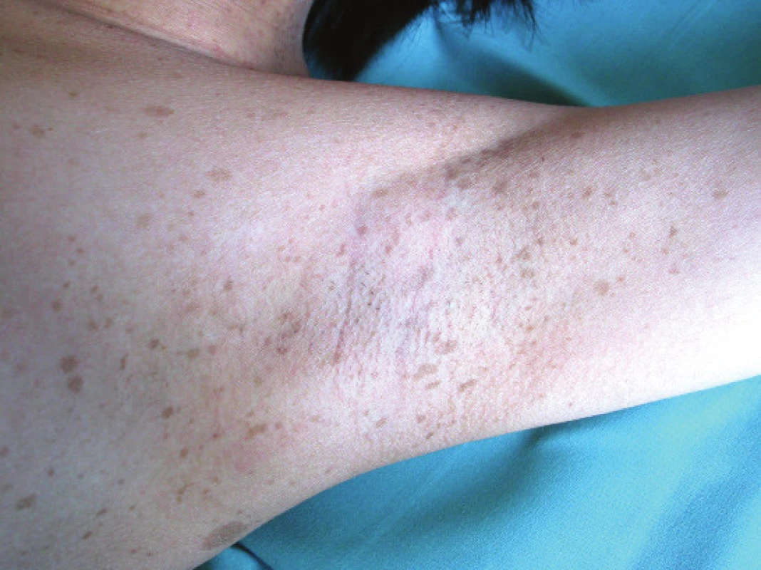 Freckling in underarm<br>
Source: Paediatric Clinic, Faculty of Medicine, Masaryk
University and University Hospital Brno