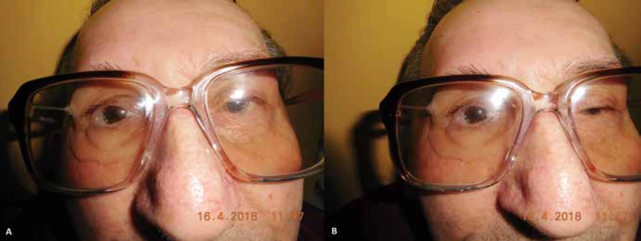 (A,B) Pacient s nasadenou epitézou v ráme okuliarov (04/2018)