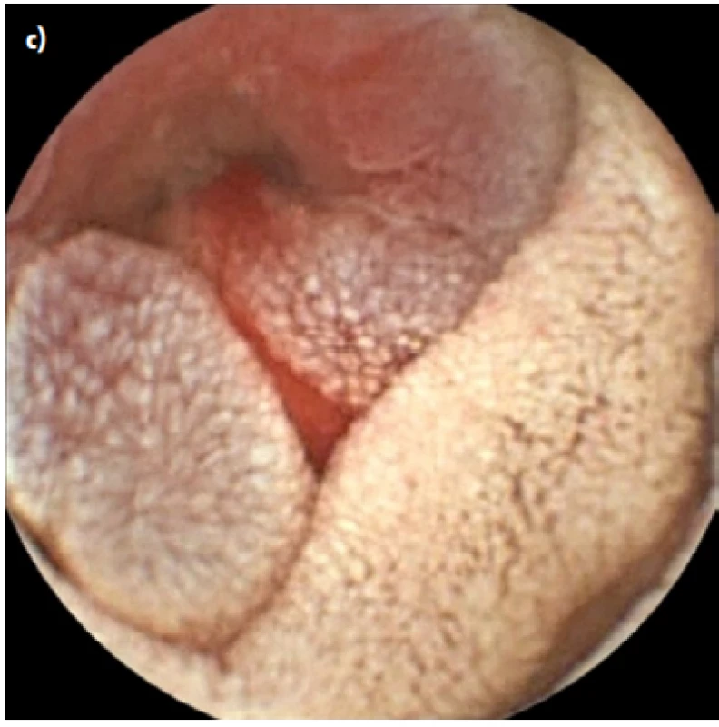 VCE showing malignant tumor of the small bowel (a, b), with apparent bleeding (c)