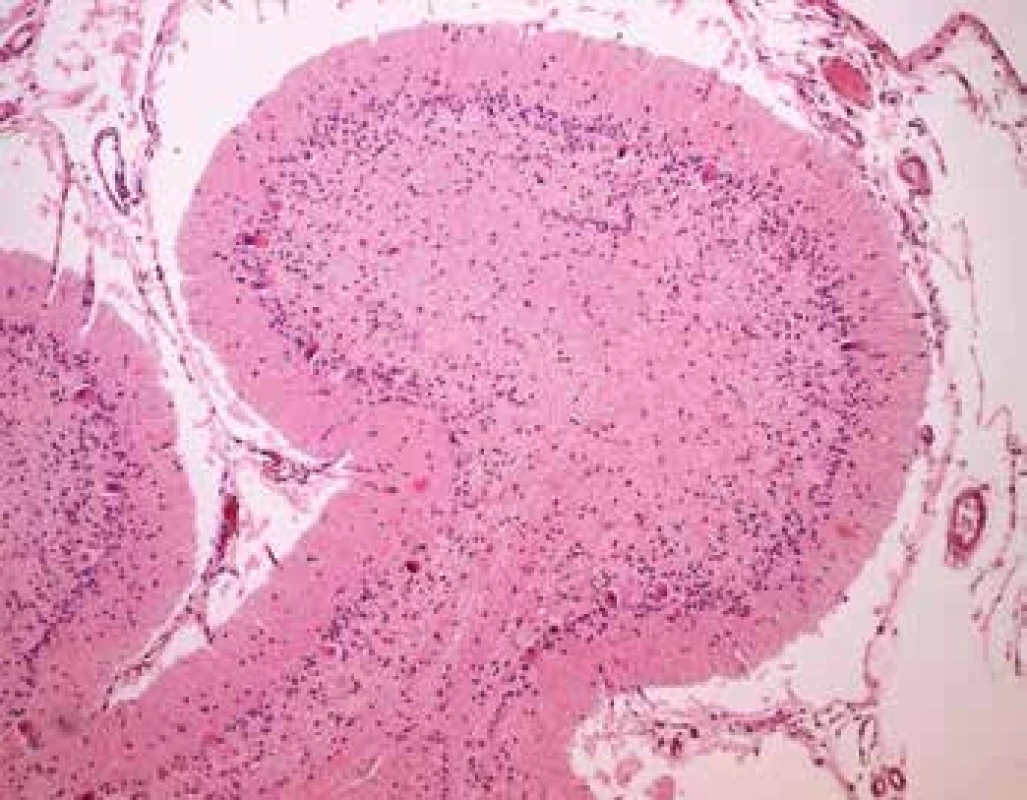Prejasnenie a zväčšenie objemu Purkyňových buniek s výraznou depléciou
neurónov hlavne stratum granulosum (farbenie HE, zväčšenie 100x).