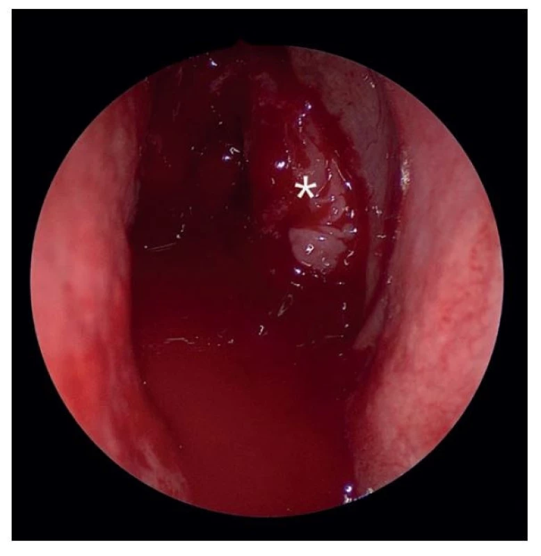 Nepřehledné operační pole zalité krví, střední skořepa (hvězda), pravá nosní dutina, endoskopický pohled