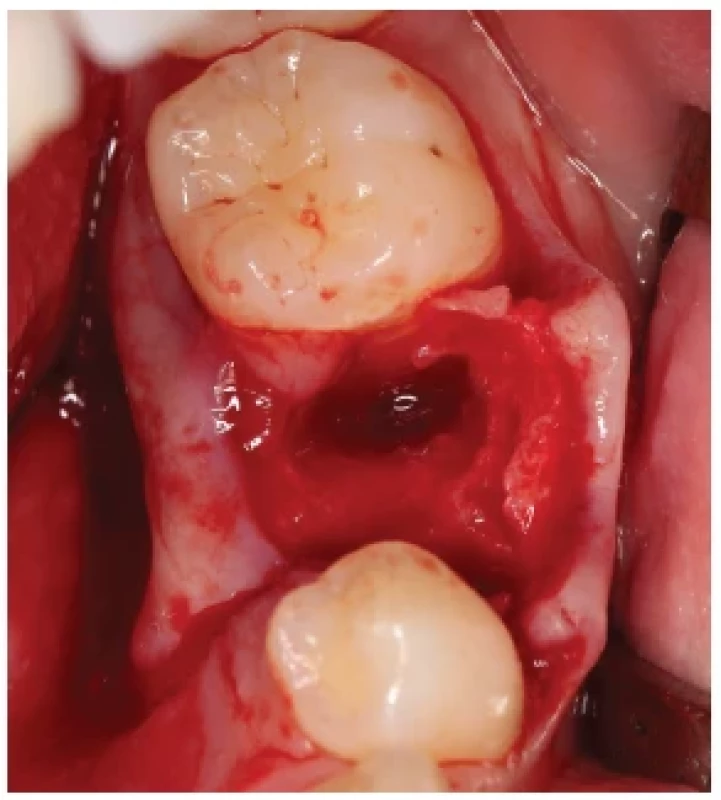 Stav po extrakci zubu 75
a vybavení retinovaného
premoláru 35. <br> 
Fig. 1.
The status after extractions
of tooth 75 and impacted
tooth 35.