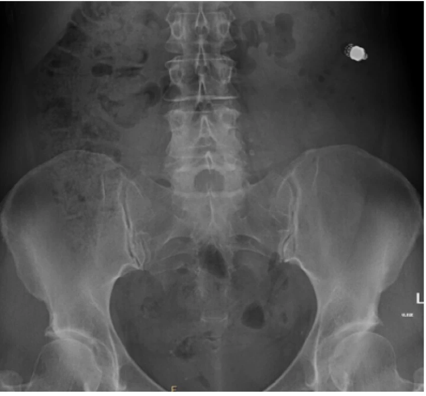 A visible capsule on the abdominal x-ray