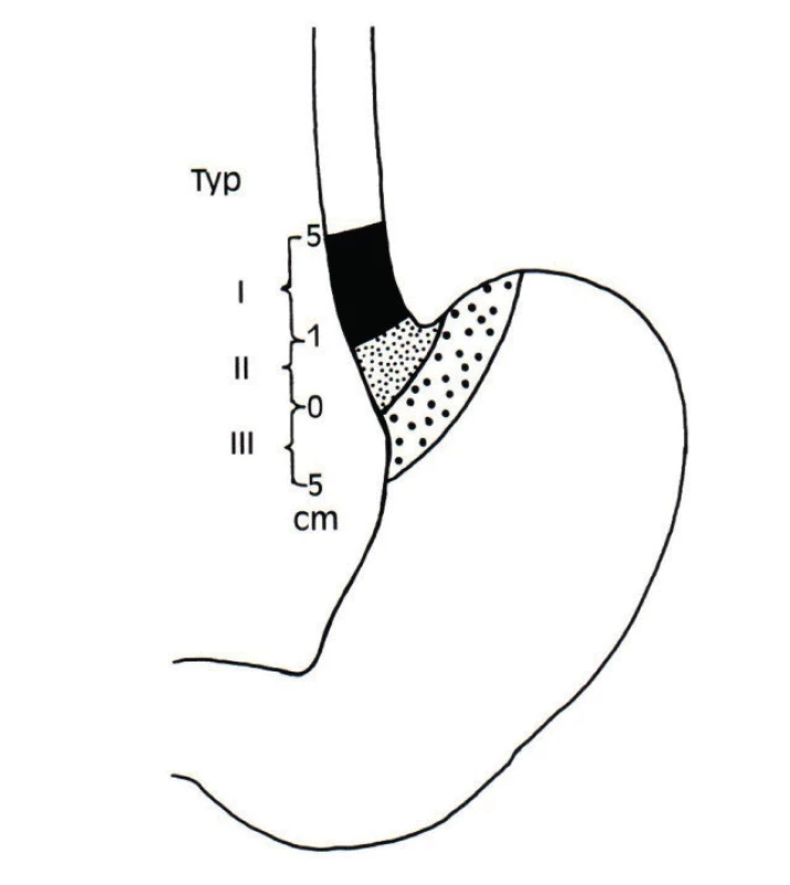 Siewertova klasifikace nádorů [3] v oblasti GEJ<br>
Fig. 1: Siewert classification of tumors [3] located at the
esophago-gastric junction