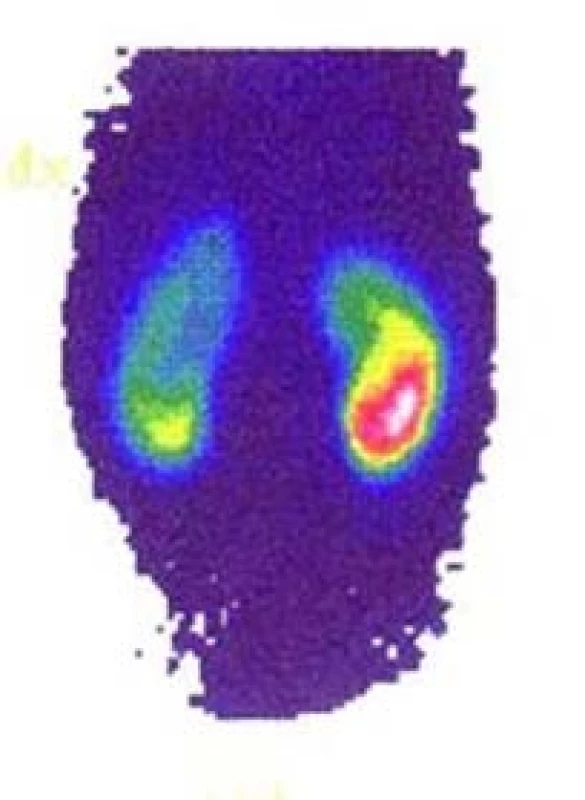 DMSA s oboustranným závažným postižením;
levá ledvina 46 %, pravá 54 % funkce (archiv
autora)<br>
Fig. 4. DMSA scan with severe bilateral scarring
