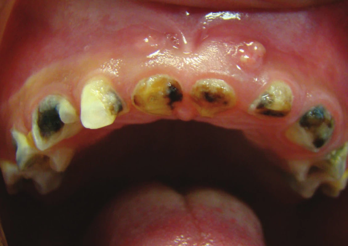 The carious primary dentition of the 36-months-old child with inflammatory complication mani-fested as the parulis on the alveolar mucosa of upper jaw, left side