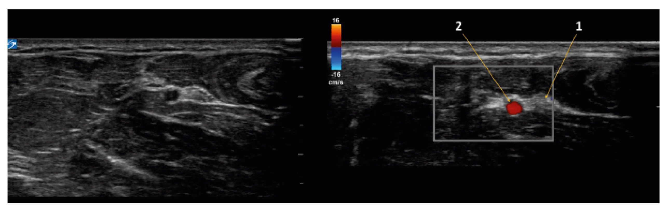 Ultrazvukový obraz (colour doppler) ulnární části středního předloktí
1 – ulnární nerv, 2 – ulnární tepna ve společné fascii mezi flexory ruky