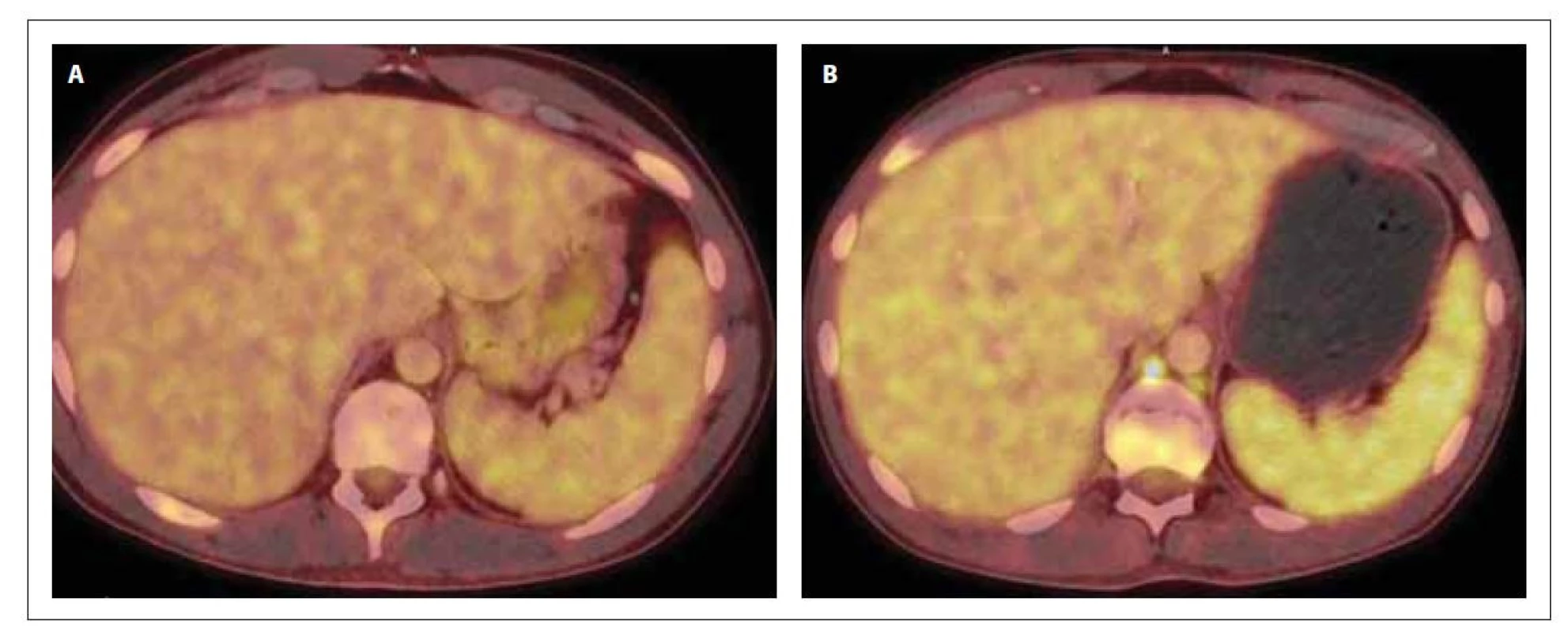 PET/CT sleziny v době diagnózy (A) a po 1. konsolidaci (B). Slezina bez patologického nálezu (A) a s prokázaným
hypermetabolizmem 18F-FDG (B) difuzně ve slezině vel. 134 x 39 x 128 mm (SUVmax 4,6), bez ložiskových změn
a ve 2 lymfatických uzlinách retroperitonea.