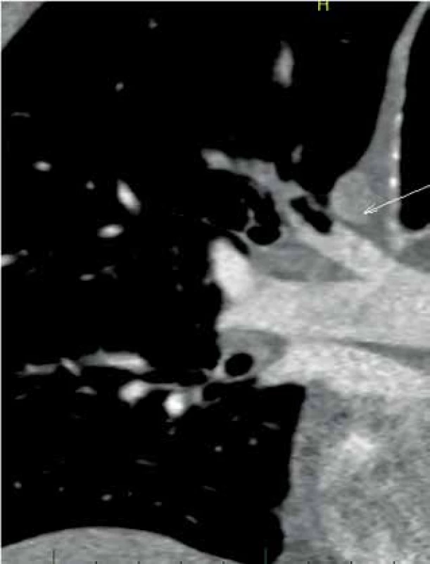 CT angiografie, šipka ukazuje plynovou bublinu 
ve větvi plícnice<br>
Fig. 1: CT angiography, the arrow indicates an air bubble 
in a pulmonary artery branch