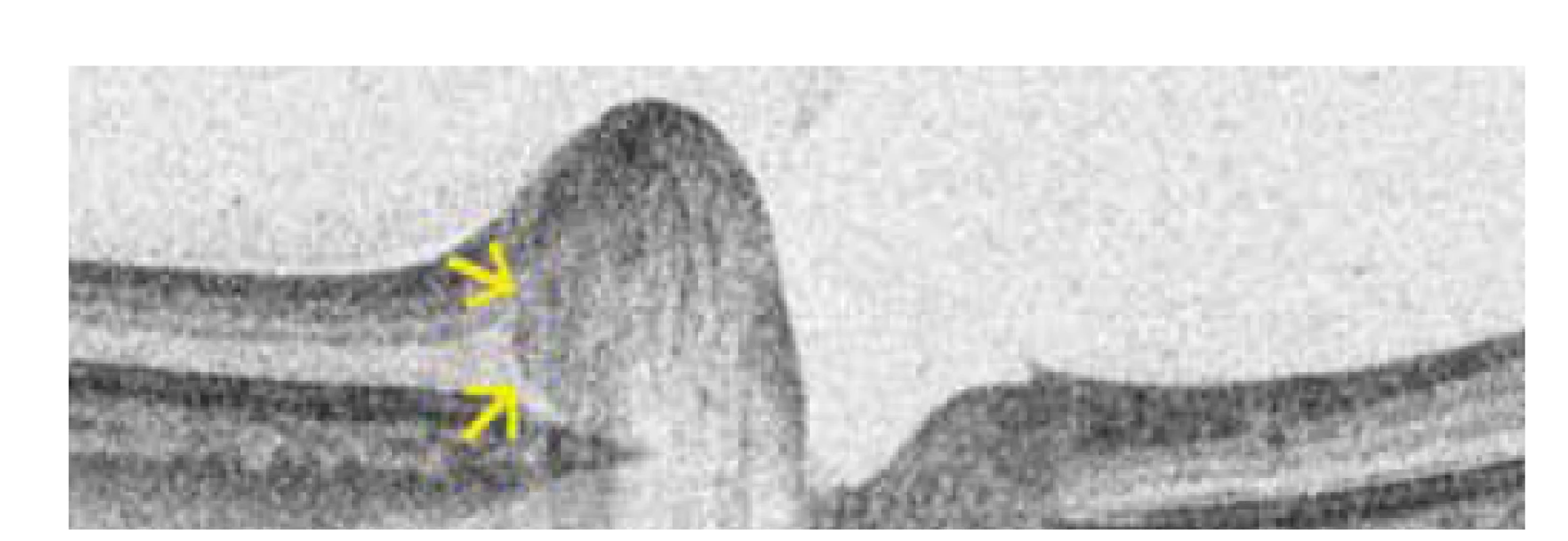 Hyperreflektivní ovoidní léze (anglicky peripapillary
hyperreflective ovoid mass-like structure, zkráceně PHOMS) terče
zrakového nervu u jednoho z našich pacientů. Toto ložisko by nemělo
být označeno jako drúza