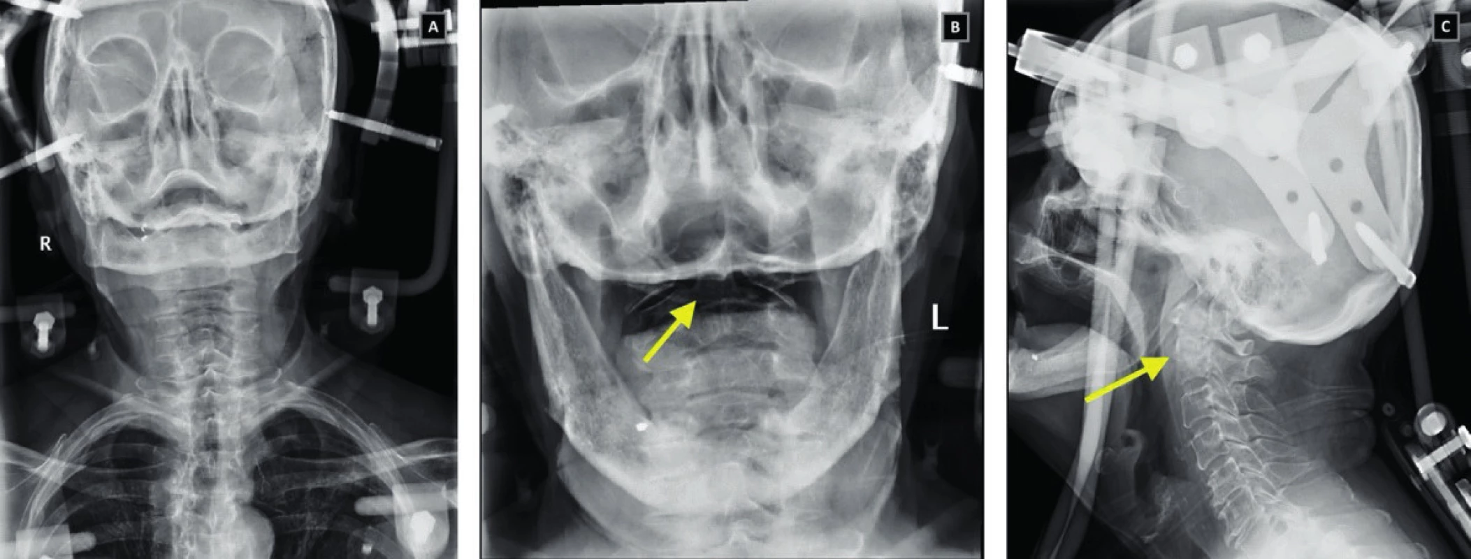 RTG snímky krční páteře v AP (A), transorální (B) a bočné (C) projekci u pacienta s frakturou dentu léčenou Halo fixací. Šipka ukazuje na místo zlomeniny