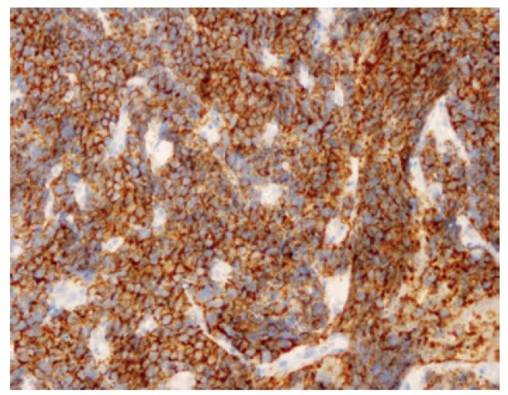 Pozitivita buněk malobuněčného karcinomu v imunohistochemickém
průkazu CD56. 200x.