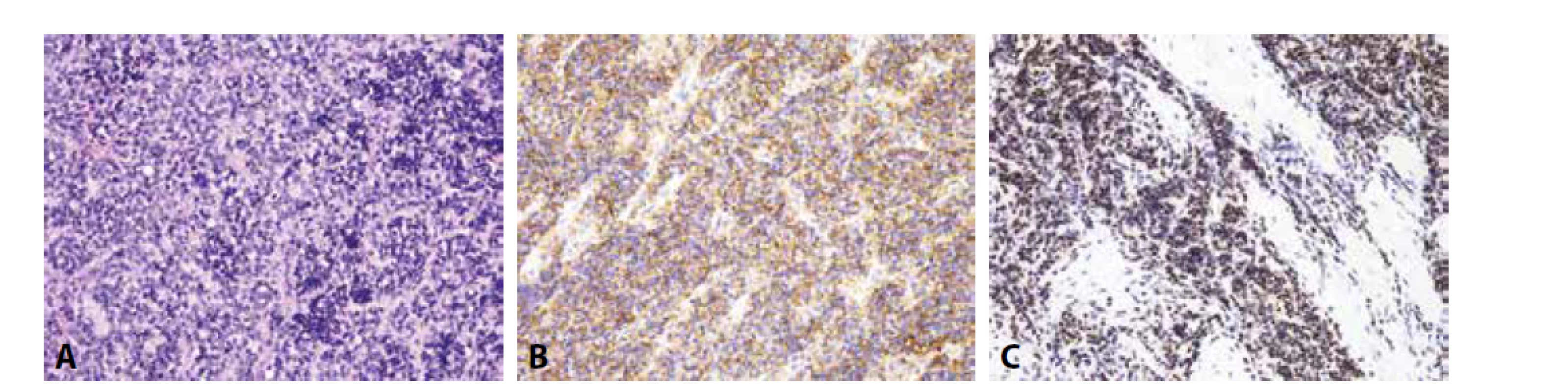 Ewingův sarkom. A) uniformní kulatobuněčný tumor (H&E); B) difúzní membránová exprese CD99; C) jaderná exprese Fli-1 (vše zvětšení
x200).