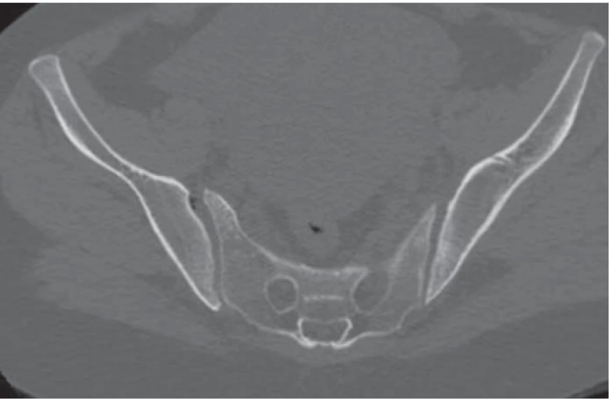 Asymetria pravého sakroilikálneho kĺbu na axiálnych CT rezoch.<br>
Fig. 2. Asymmetry of the right sacroilical joint on axial CT scans.