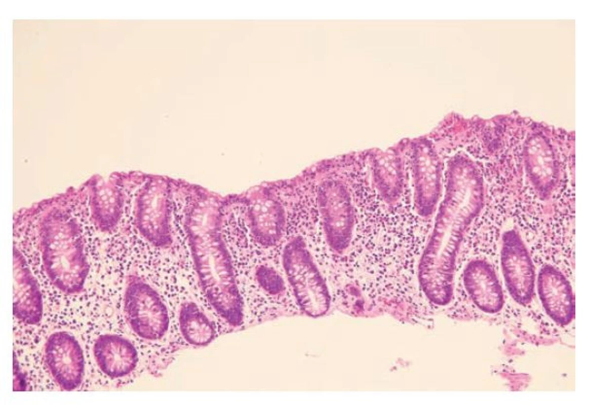 Lymfocytární kolitida. Kolická sliznice se zachovalou architektonikou
a kulatobuněčnou zánětlivou celulizací mírné intenzity v lamina propria.
V povrchovém epitelu i ve výstelce krypt jsou patrny početné intraepiteliální
lymfocyty a povrchový epitel vykazuje regresivní změny a depleci
hlenotvorby (hematoxylin a eosin; 100x).