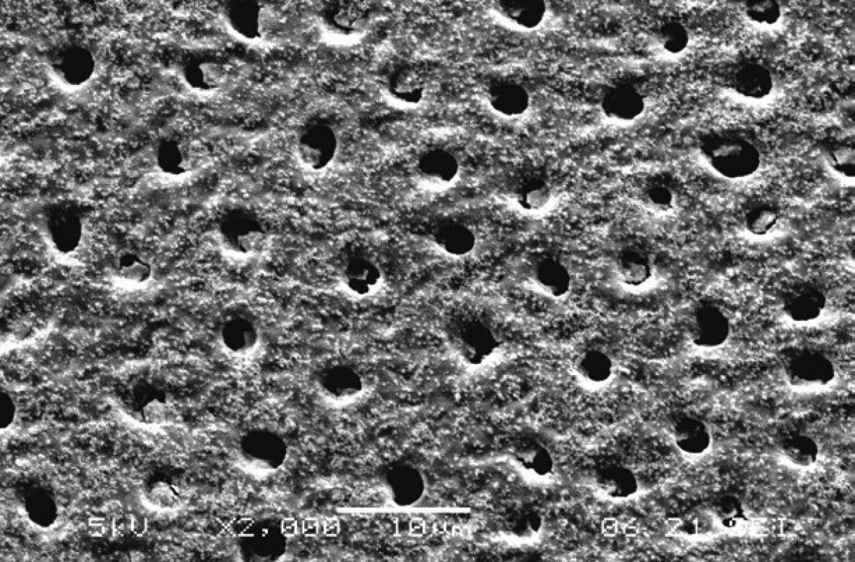 Dentin surface with open dentinal tubules after phosphoric acid etching. Remnants of silica particles from the etching gel were observed.
Scanning electron microscope, magnification 2000×.

