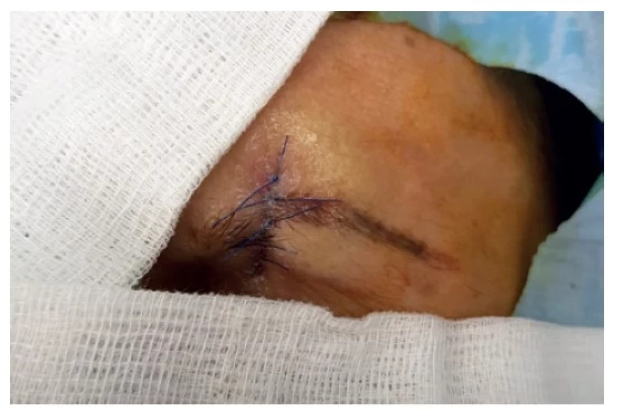 Stav po chirurgické korekci jizvy<br>
Fig. 3: Condition after surgical revision of the scar