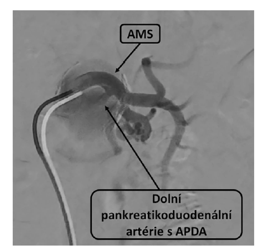 Angiografie, horní mezenterická tepna a dolní
pankreatikoduodenální tepna<br>
Fig. 2: Angiography, superior mesenteric artery and inferior
pancreaticoduodenal artery