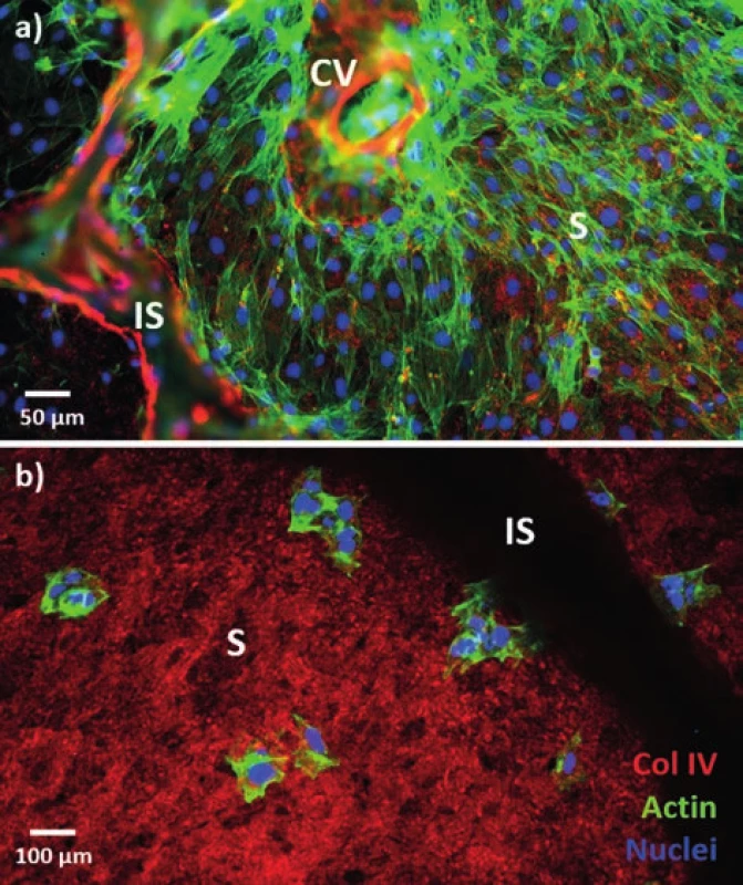 Fluorescenční obrázek buněk v decelularizovaném
skeletu prasečích jater
a) potkaní endotelové buňky po 7 dnech inkubace; b) buňky
linie HepG2 3h po aplikaci; zeleně je značen buněčný cytoskeleton,
červeně kolagen IV prasečího skeletu a modře buněčná
jádra. Oba typy buněk byly aplikovány metodou „drop
seeding“.<br>
Fig. 4: Fluorescence image of cells in the decellularized
pig liver scaff old
a) rat endothelial cells after 7 days of incubation; b) HepG2
cells 3h after seeding; the cytoskeleton is green, red is used
for collagen IV from the pig scaff old, and blue depicts the
nuclei. Drop seeding was used in both cases.
Vysvětlivky: S – sinusoidy, CV – centrální žíla, IS – interlobulární septum;
S – sinusoids, CV – central vein, IS – interlobular septum.