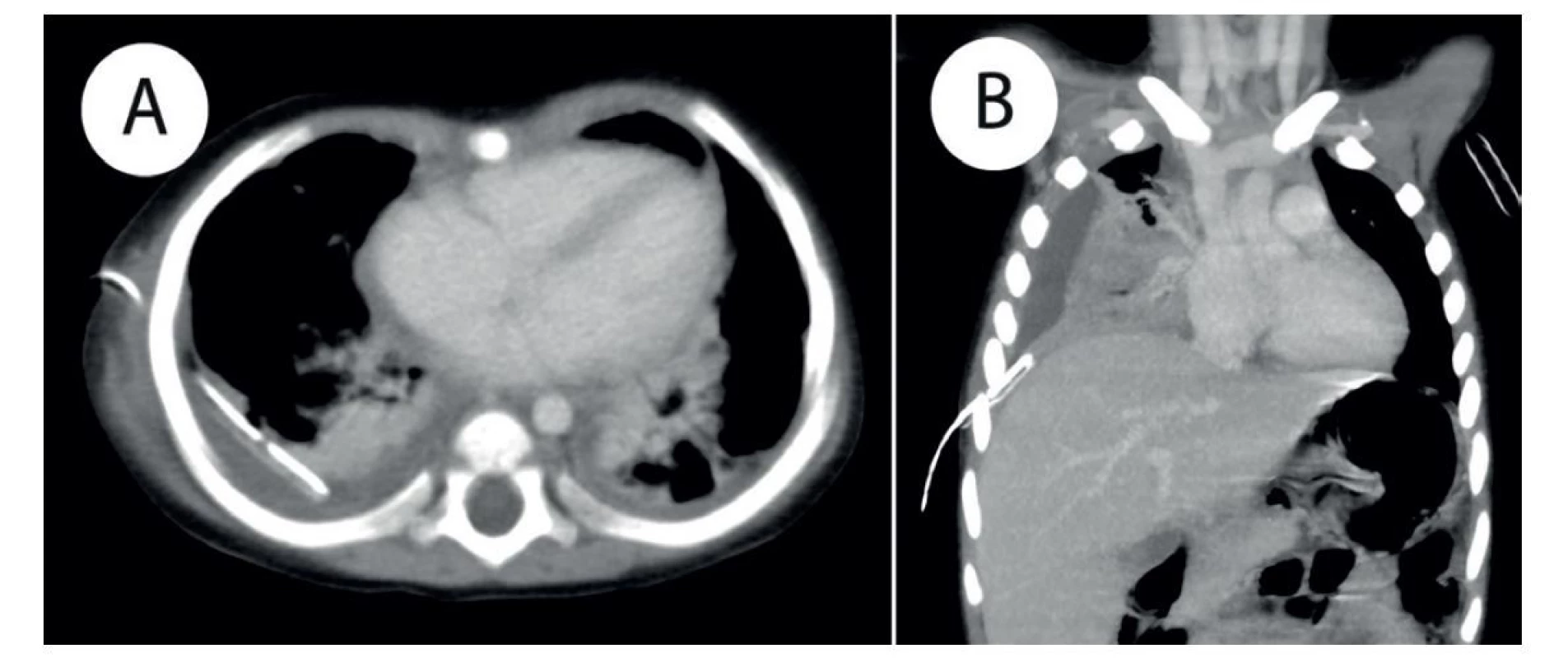 a) CT vyšetření po podání KL, tra rekonstrukce − pravostranná pleuropneumonie s pleurálním výpotkem a dorzálně
zavedeným hrudním drénem; b) CT vyšetření po podání KL, cor MIP rekonstrukce − pravostranná pleuropneumonie s pleurálním
výpotkem a zavedeným hrudním drénem.<br>
Fig. 2: a) Postcontrast CT examination, tra reconstruction − right sided pleuropneumonia with pleural effusion and chest
tube placed in the posterior pleural recess; b) postcontrast CT examination, cor MIP reconstruction − right sided pleuropneumonia
with pleural effusion; chest tube in place.