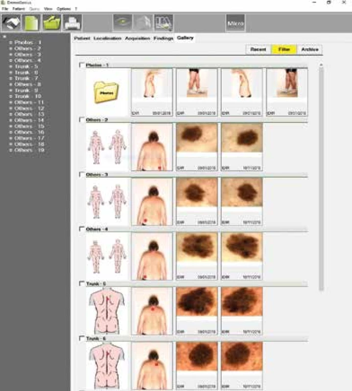 Digitální dermatoskopie vybraných lézí
v aplikaci DermoGenius