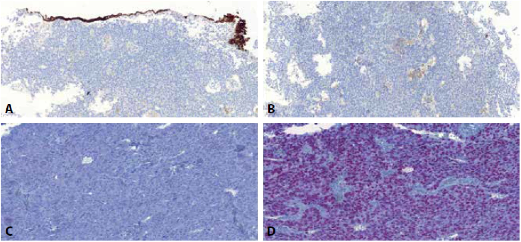 Imunohistochemický obraz u high-grade prostatického adenokarcinomu napodobujícího uroteliální karcinom - nádorové buňky jsou negativní v CK7 - pozitivní vnitřní kontrola je povrchový urotel, který je pozitivní (A), negativní v CK20 (B) a GATA3 (C). Naopak nádor exprimuje NKX3.1 - jaderná pozitivita (D).