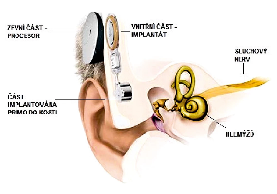 Implantát pro kostní vedení Bonebridge. Tvoří jej
zevní část obsahující procesor a vnitřní část implantovaná
pod periost za uchem a do kosti.
Upraveno se svolením firmy Medel.